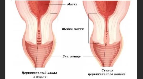 Что такое стеноз шейки матки