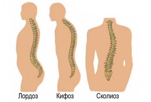 Типы деформации осанки, ее причины, лечение