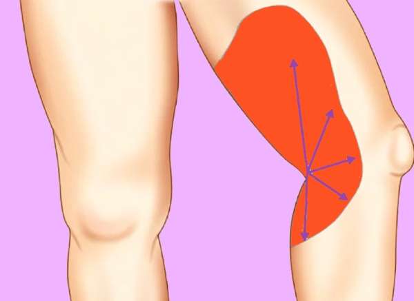 Как убрать жир с внутренней стороны коленей, похудеть над коленями