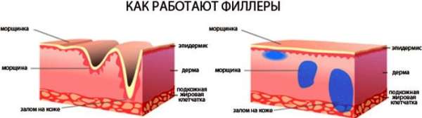 Фотоомоложение Candela Nordlys. Отзывы, цена