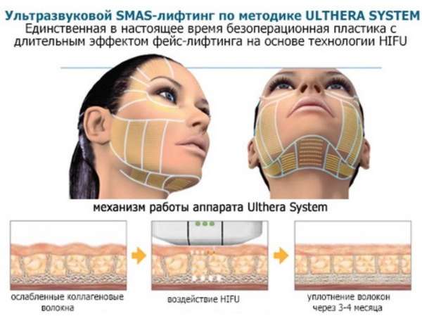 Смас-лифтинг. Отзывы с фото до и после, цена