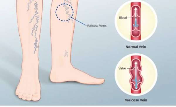 Варикоз: неявные симптомы и методы лечения