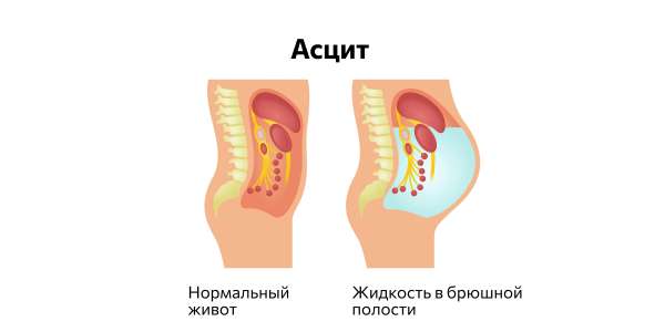 Может ли форма живота рассказать что-то о здоровье — Лайфхакер Здоровье